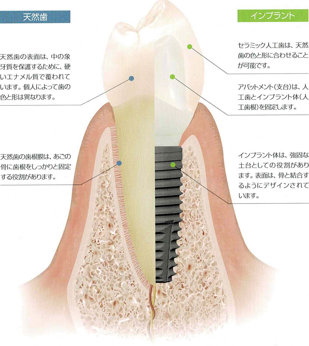 インプラントとは