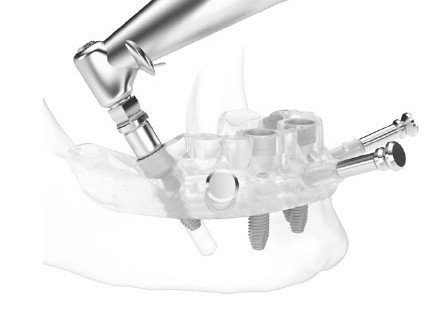 サージカルガイドによる正確な手術