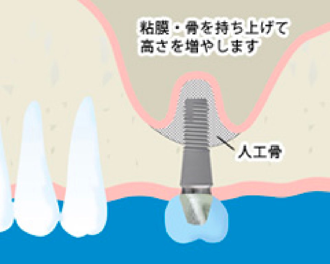 サイナスリフトやソケットリフトに対応