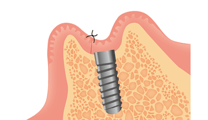 STEP2｜インプラント埋入（一次手術）