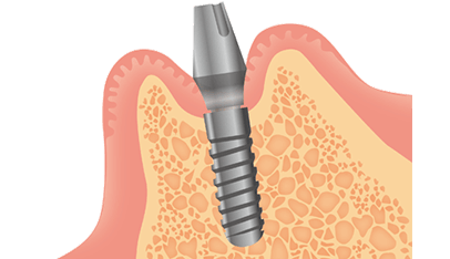 STEP3｜人工歯を装着するための準備（二次手術）