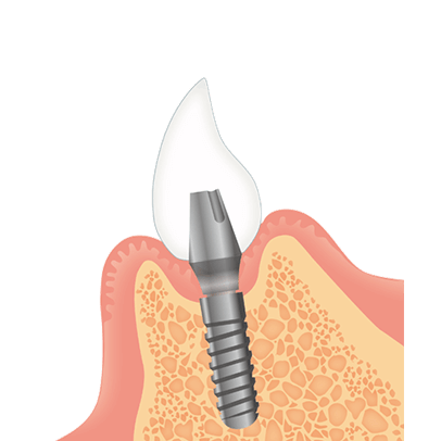 STEP4｜人工歯の装着（治療完了）