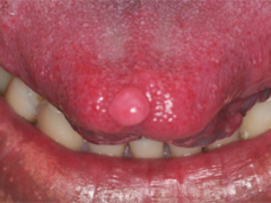 線維腫（せんいしゅ）