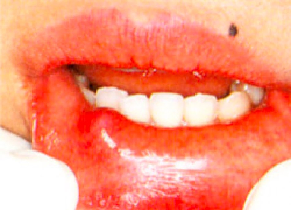 粘液嚢胞（ねんえきのうほう）