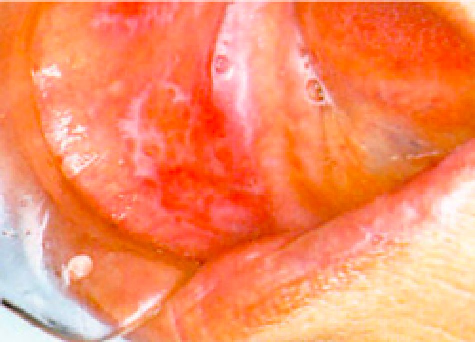 扁平苔癬（こうくうへんぺいたいせん）