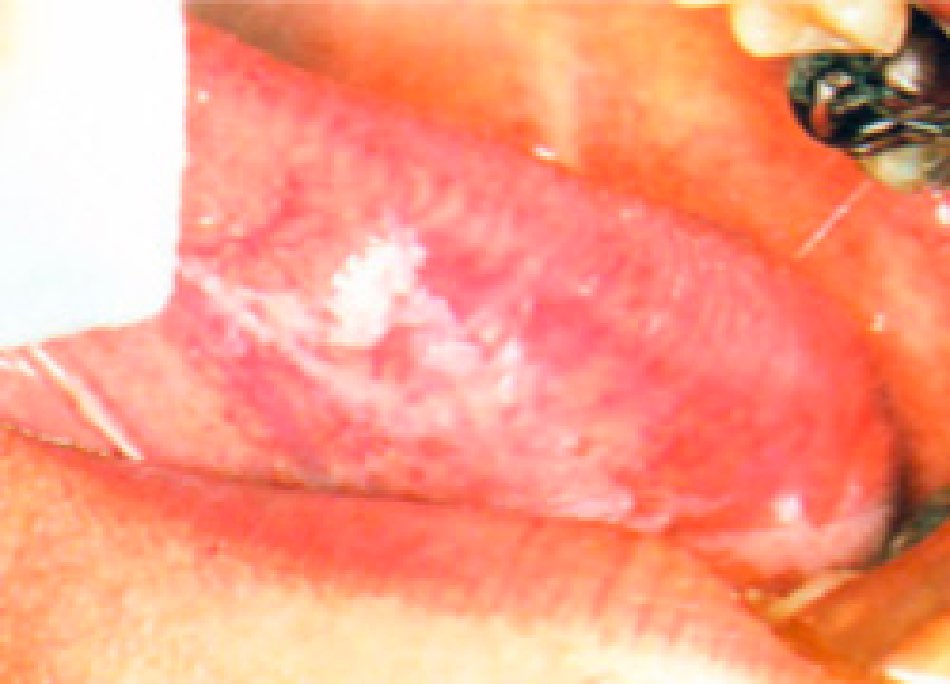 白板症（はくばんしょう）