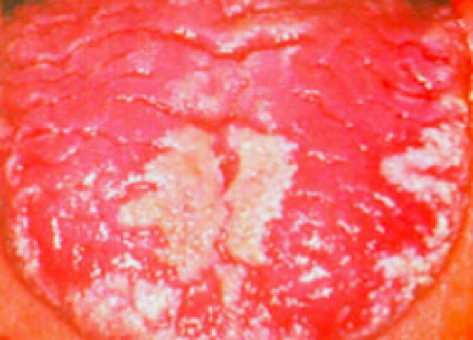 口腔カンジダ症