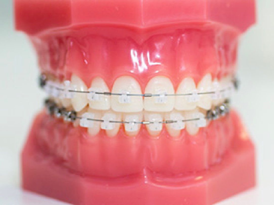 目立ちにくい装置を使った矯正治療