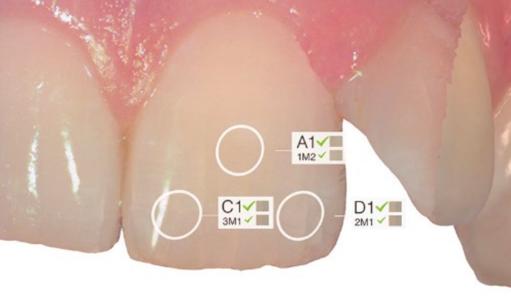 3｜シェード測定機能による緻密な色の測定